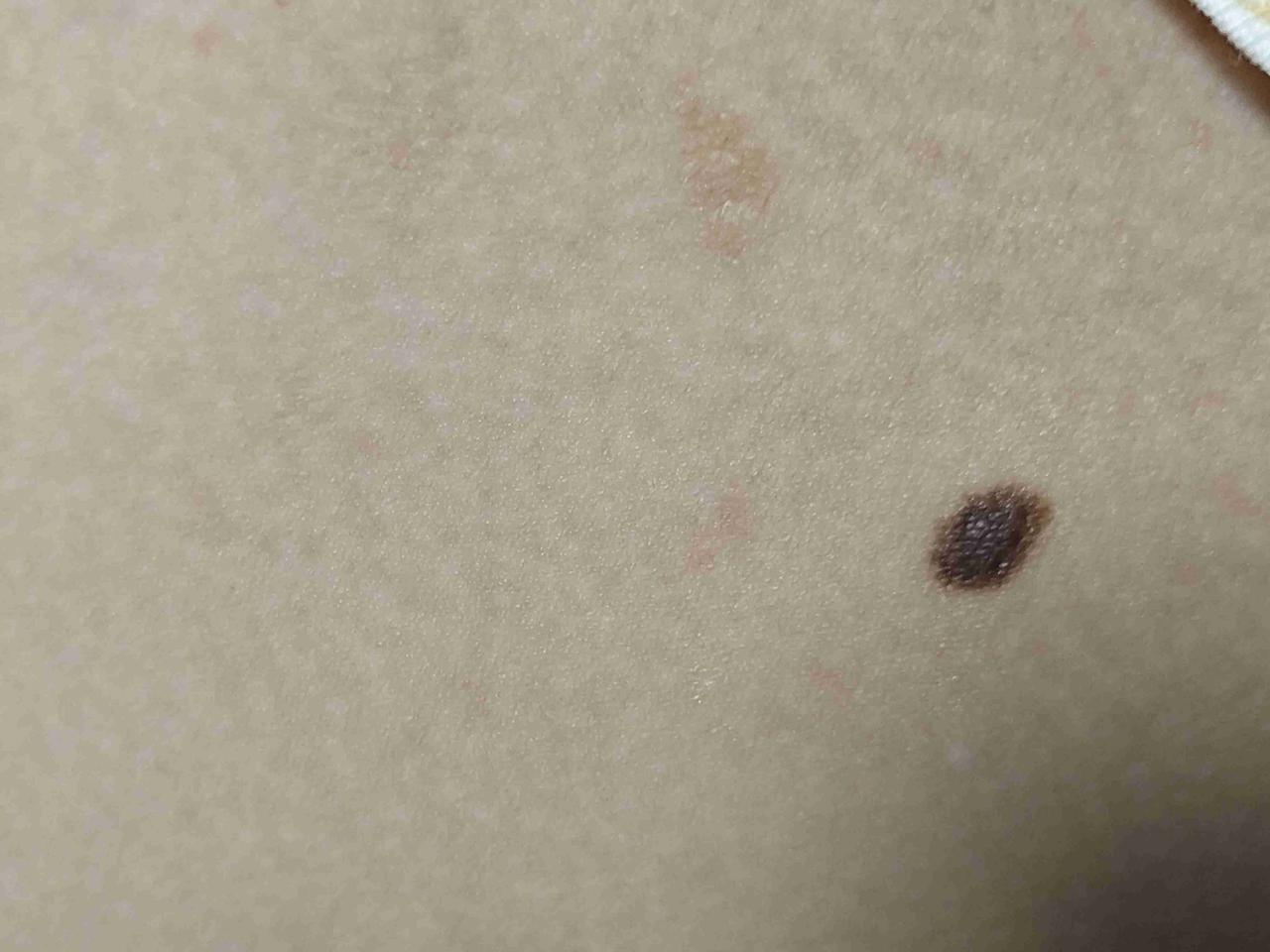 二宝一出生大腿根就有个黑痣，随着年龄增长也在增长，有懂的吗？？