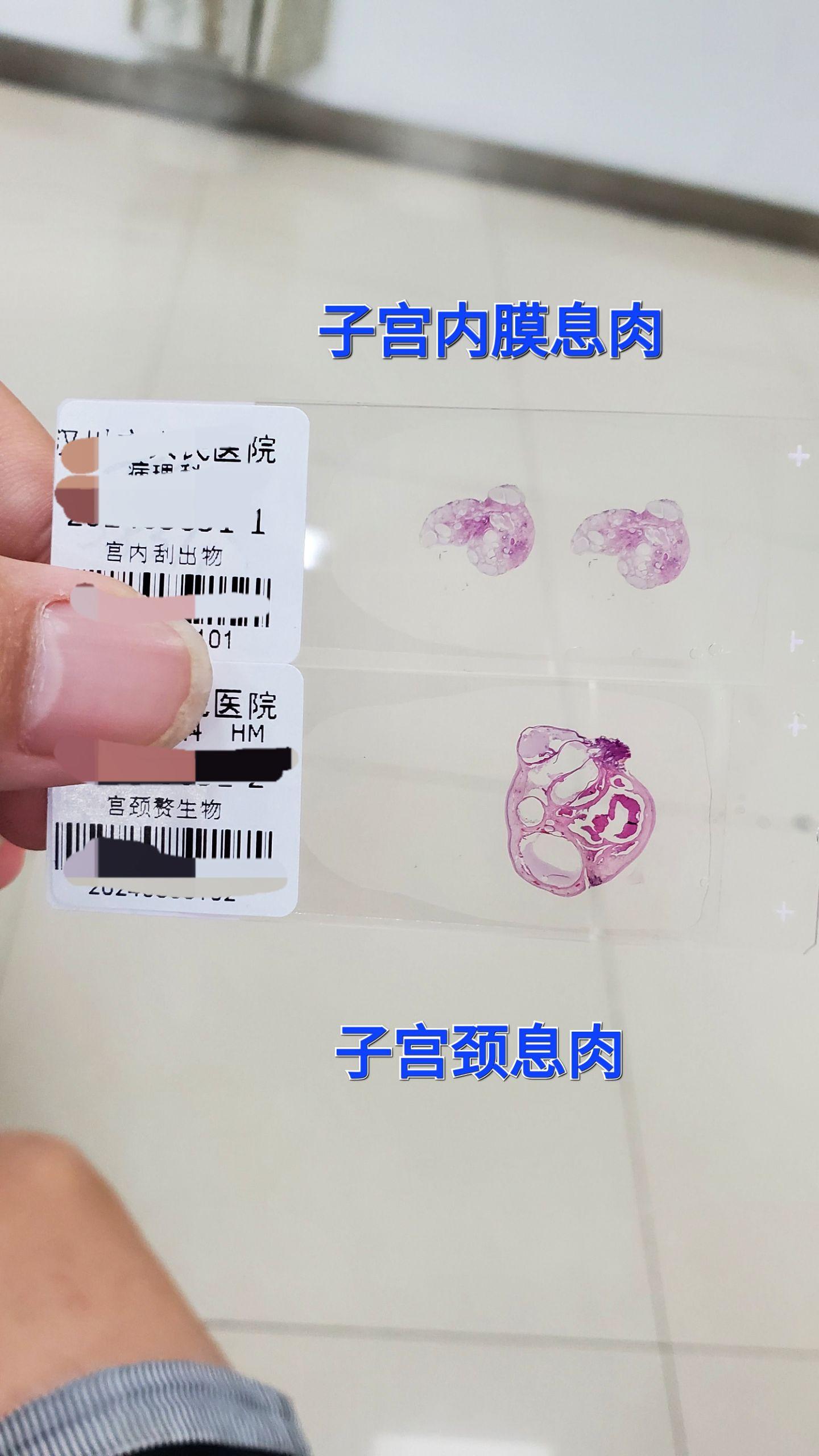 子宫息肉