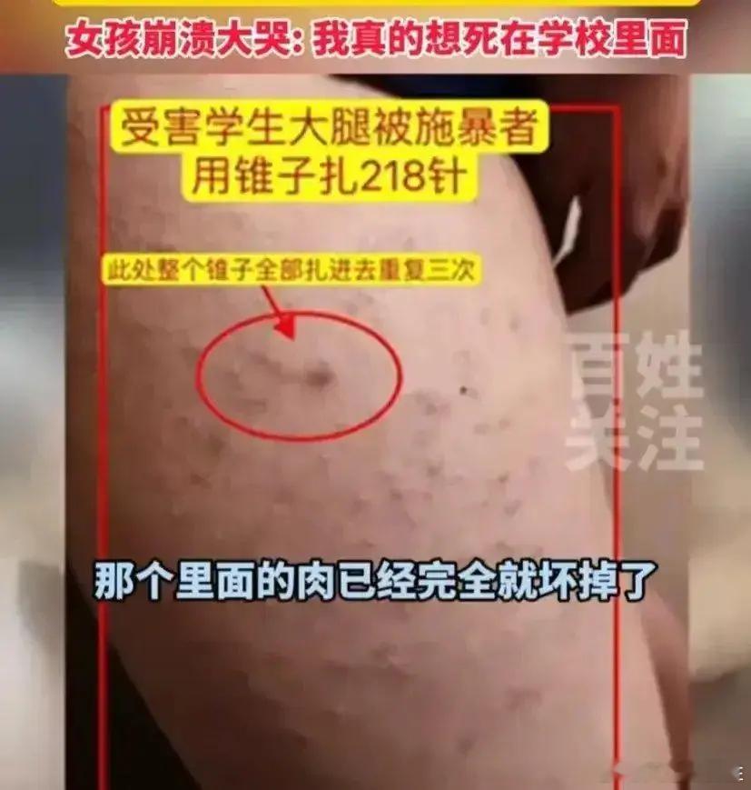 #女生被扎218针为何未达校园霸凌标准##校园霸凌# 这种校园霸凌已经严重触犯法