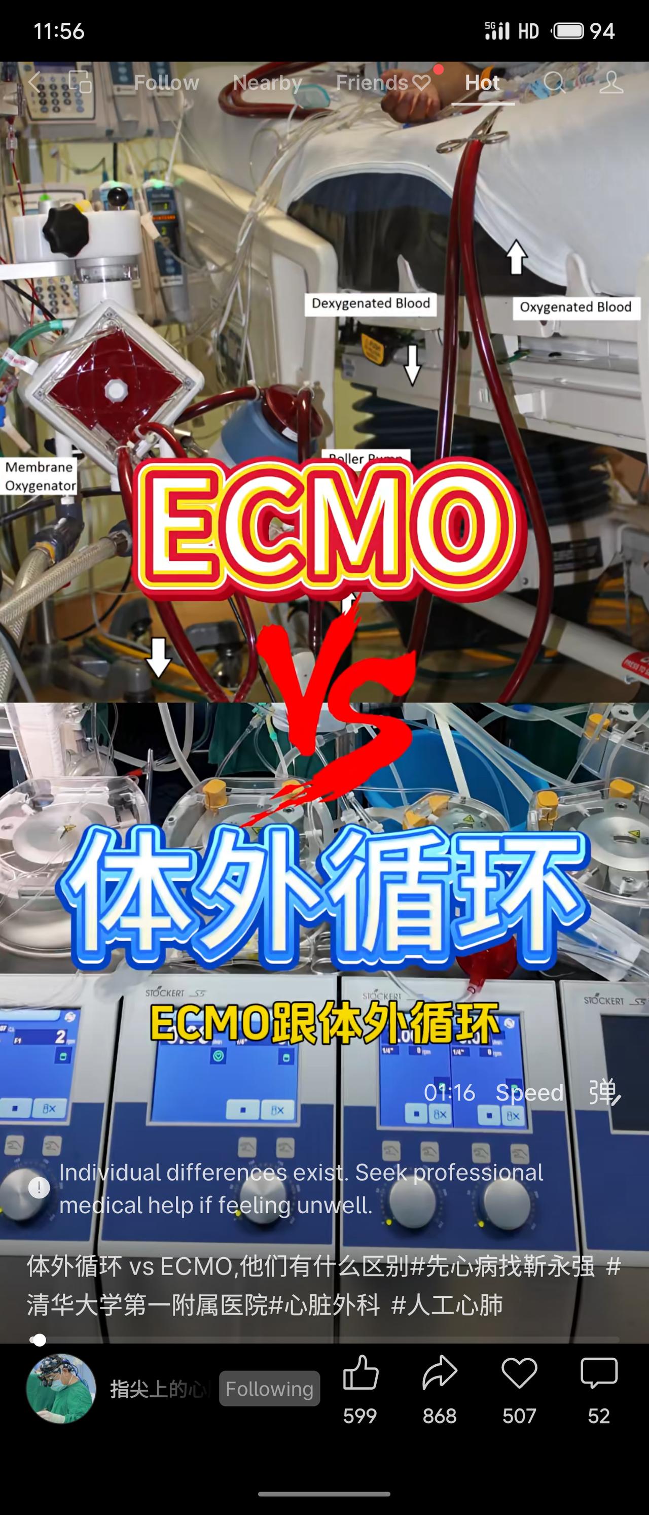 体外循环与ECMO（体外膜肺氧合）都常被称为“人工心肺机”，但两者在应用场景、使
