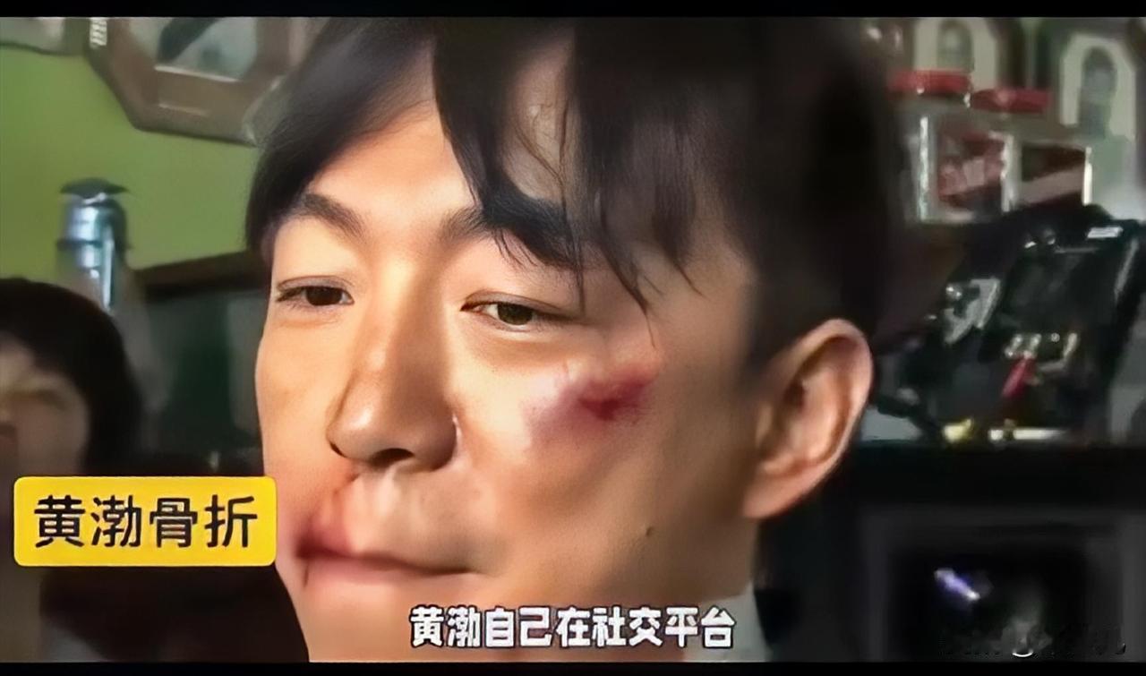 喜剧演员就是自带喜感，
连骨折都说得那么有意思：
就是在家门口拐个弯，就倒了。