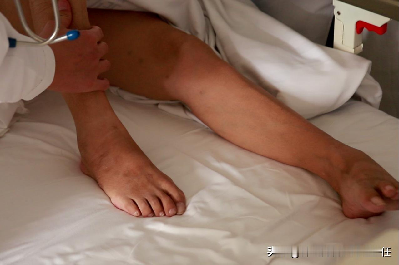 偏瘫患者为什么一到晚上就抽筋？可能不是缺钙
 
这种抽筋其实在临床上有个专业名词