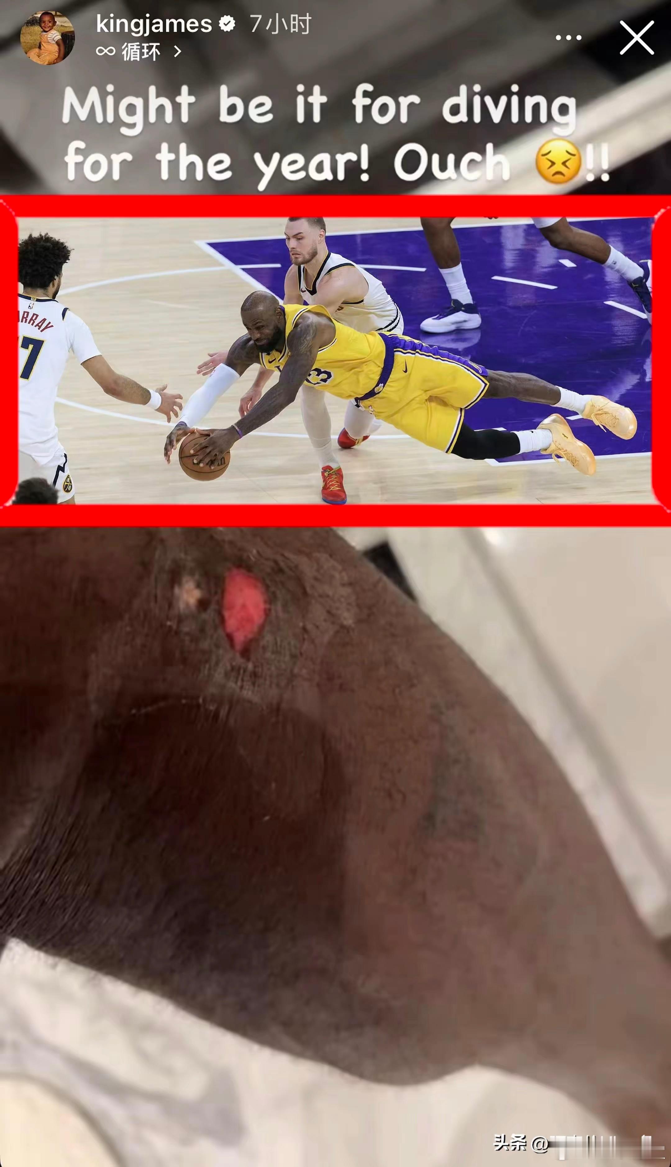 詹姆斯晒腿部伤口并配文：“这可能是我年度最佳抢球！太疼了😣” 