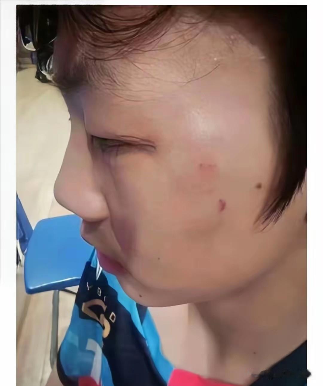 看这孩子被打的！赢了比赛，脸倒被对手揍得青一块紫一块，眼眶都肿成那样了，真是可怜