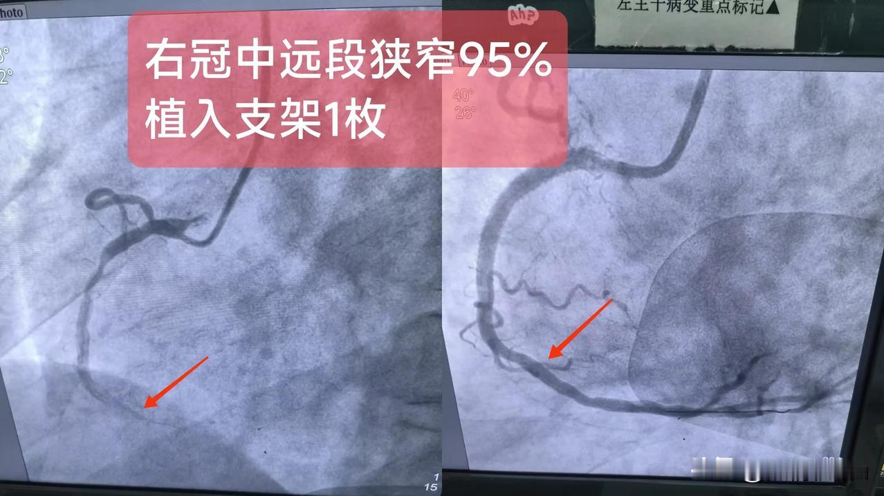 急性ST段抬高型心肌梗死
（右冠中远段狭窄95%)

一.概念：
右冠状动脉起自