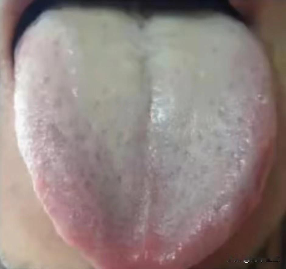 舌苔白腻的都快成了毛毯子了，还不注意，非要等到补不进去了才上心么

主诉：怕冷，