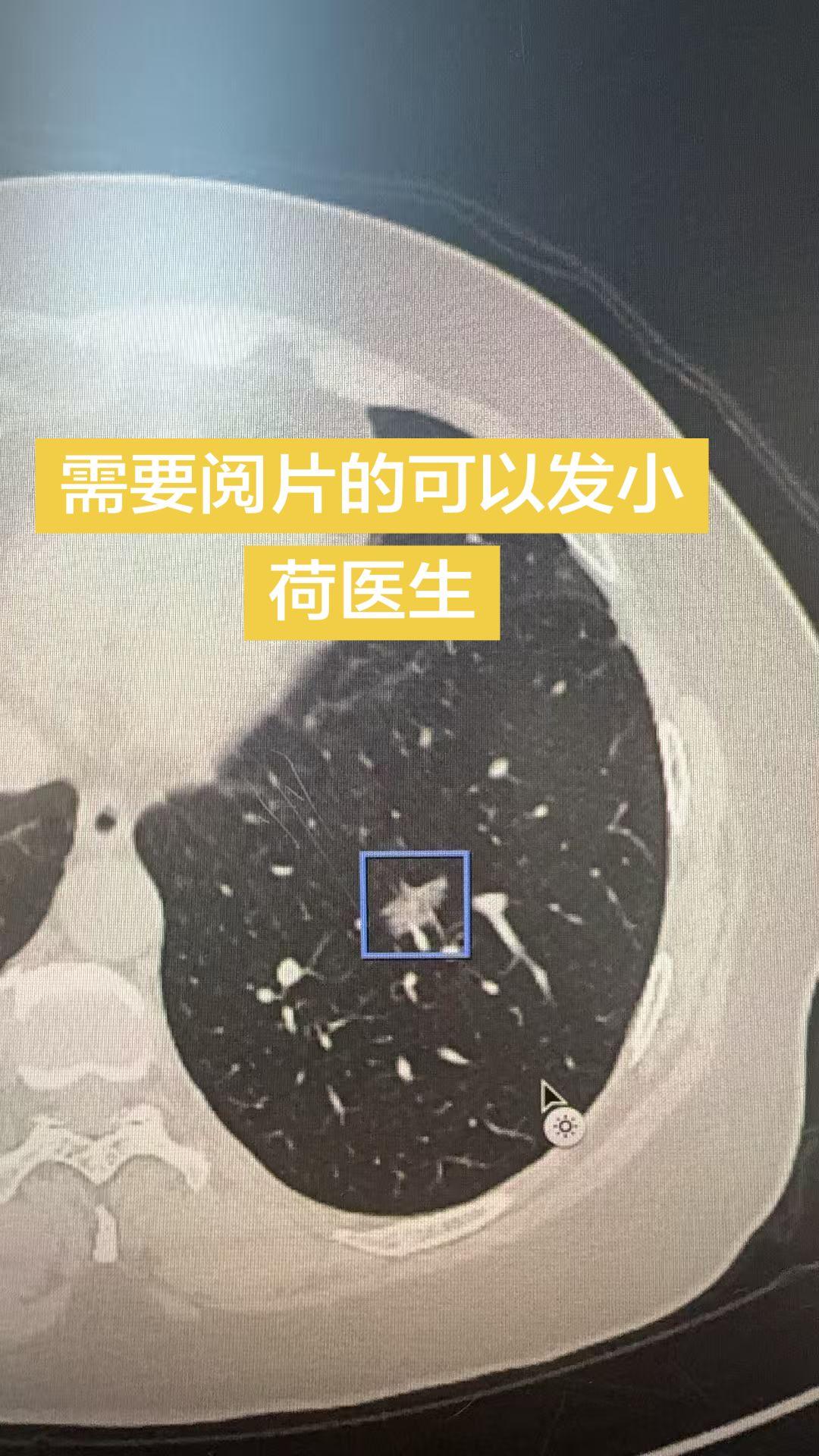 需要阅片的可以发小荷医生。需要阅片的可以发小荷医生