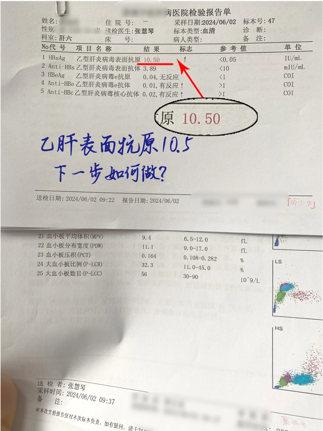 大家看这位山东患者的乙肝表面抗原降到了10