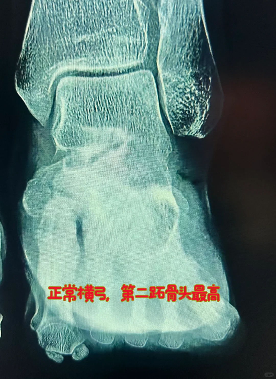 从X线片上看横弓塌陷