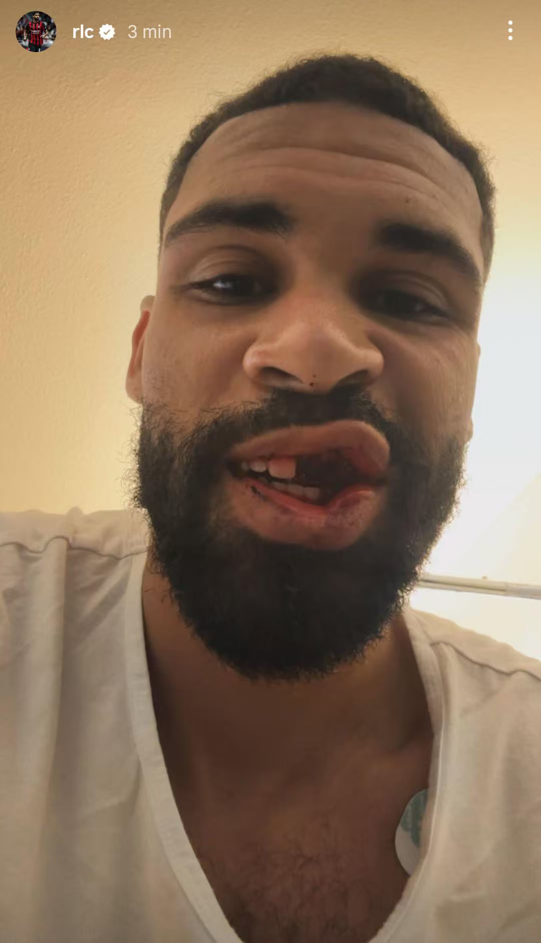 米兰官宣洛夫图斯奇克已经成功接受了手术，预计缺席两个月。他本人也在社交媒体上给大