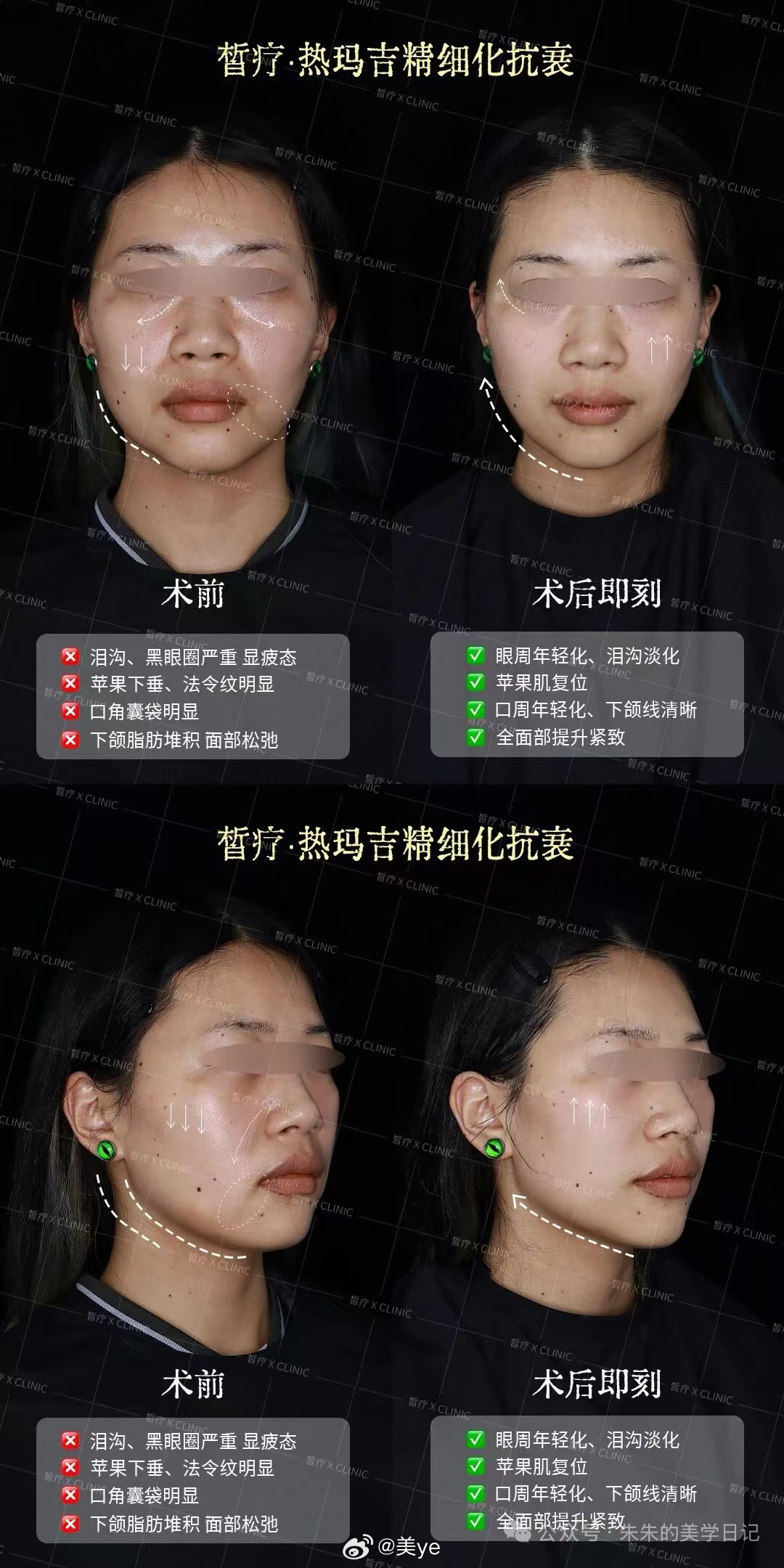 不想打针或者审美比较保守的可以先试试来找我们陈博士光电捏脸只打了热玛吉就有这种效