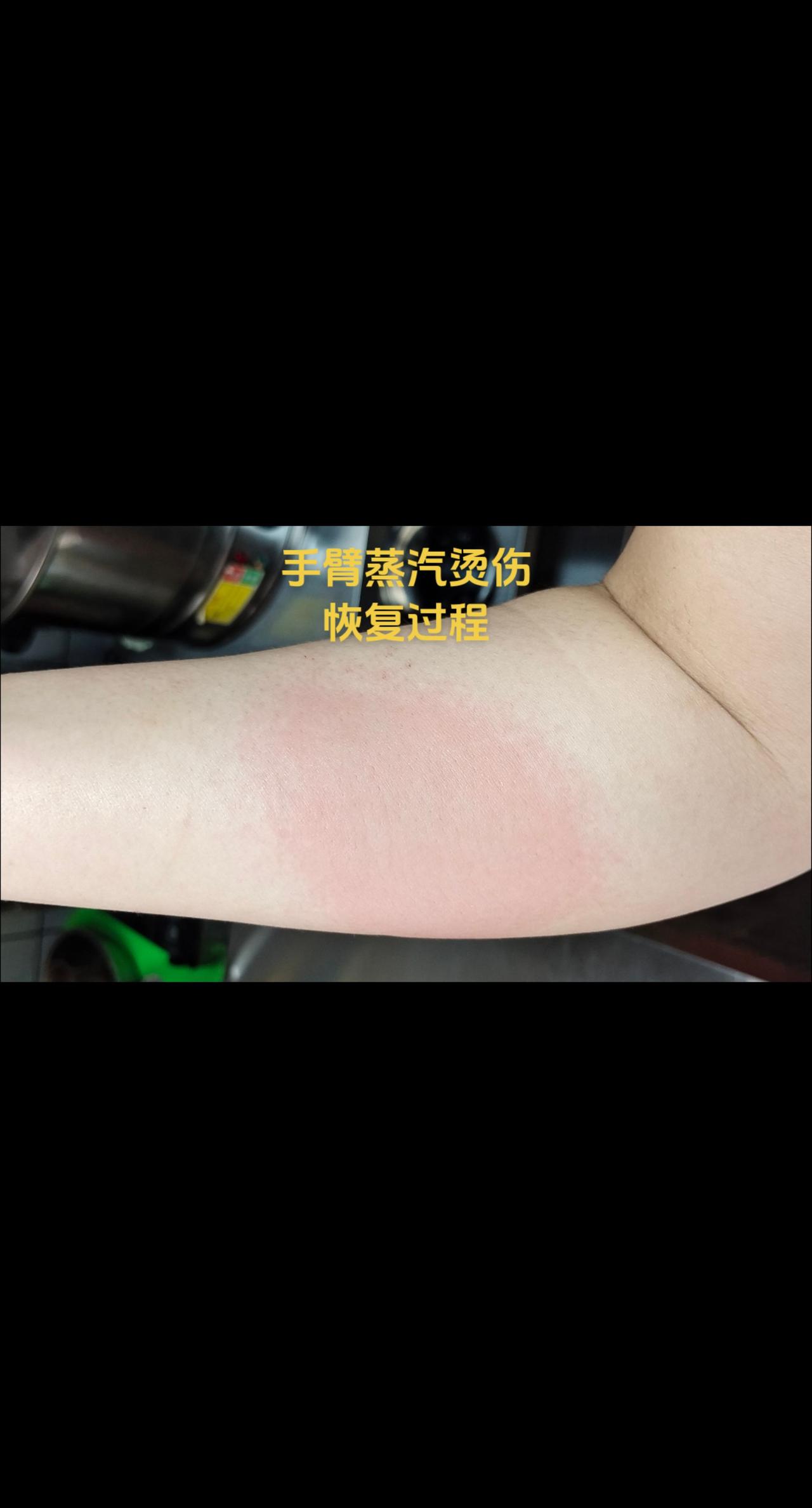 蒸汽烫伤后是非常疼的 钻心的疼
我开店的时候经常被烫伤
要么就是被割伤 流血才发