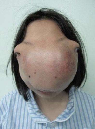 2009年，一位22岁的浙江女孩因天生面容畸形，隐匿生活了13年，终于凑够了治疗