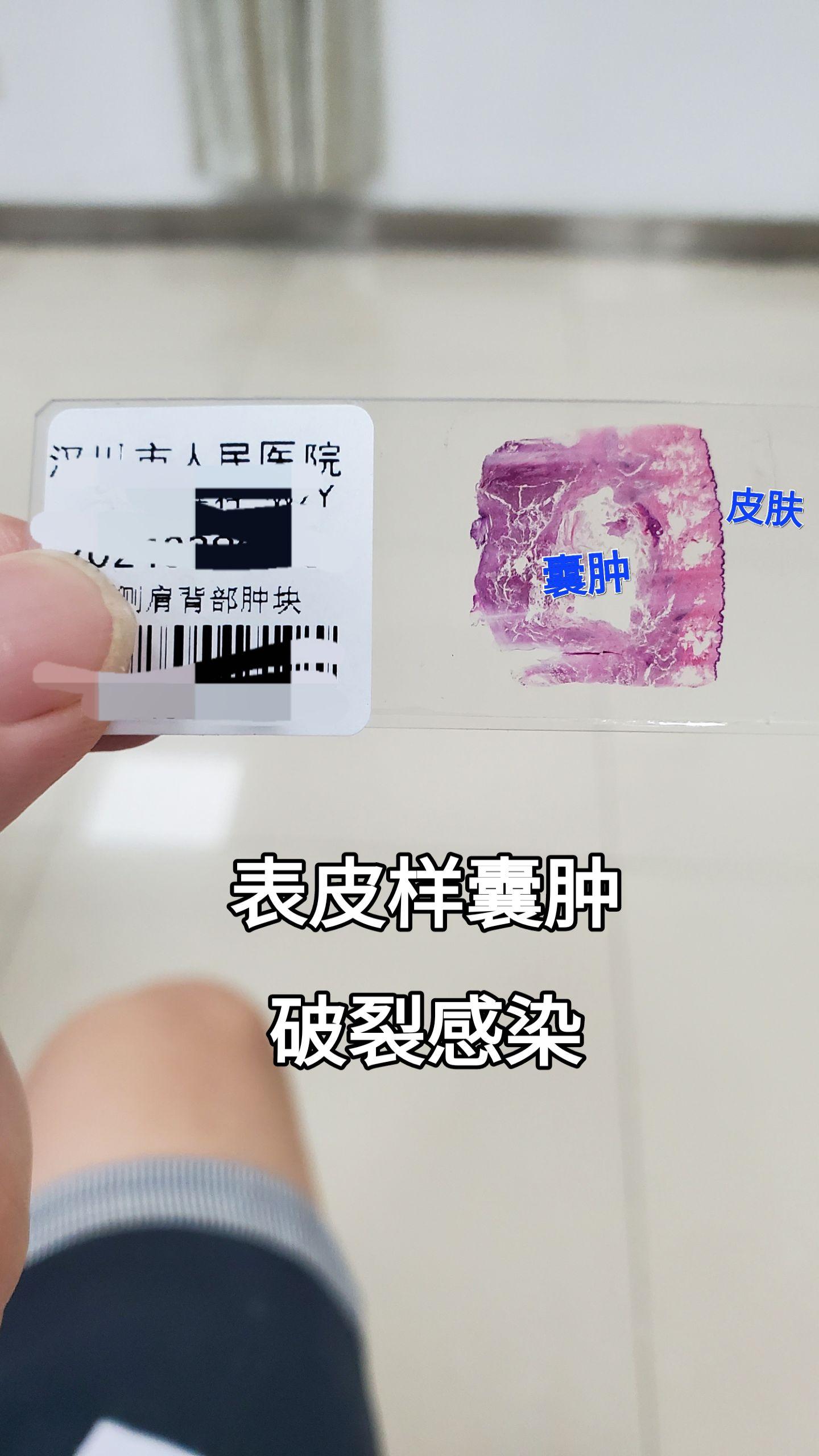 显微镜下的世界 
表皮样囊肿