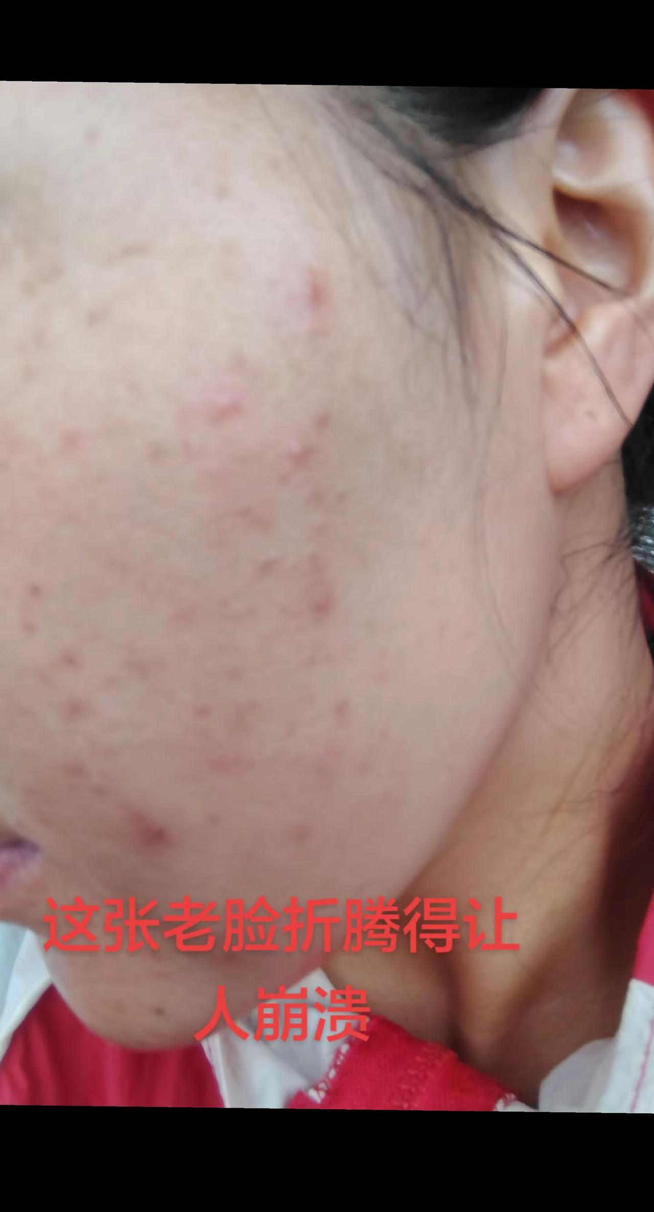 抗痘历程