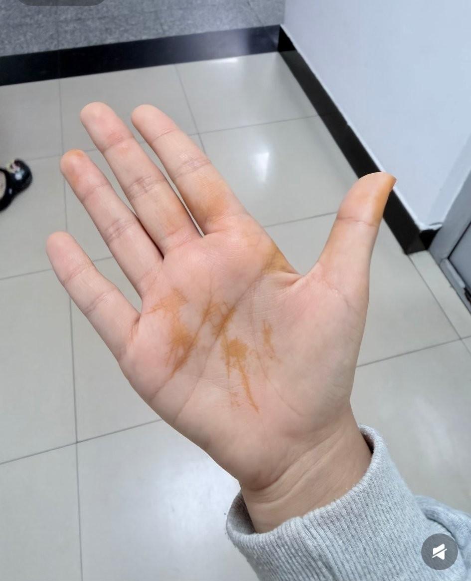 同事的手掌总是莫名其妙的起这个黄色，像碘伏水。不是外物粘的，有没有谁知道这是什么