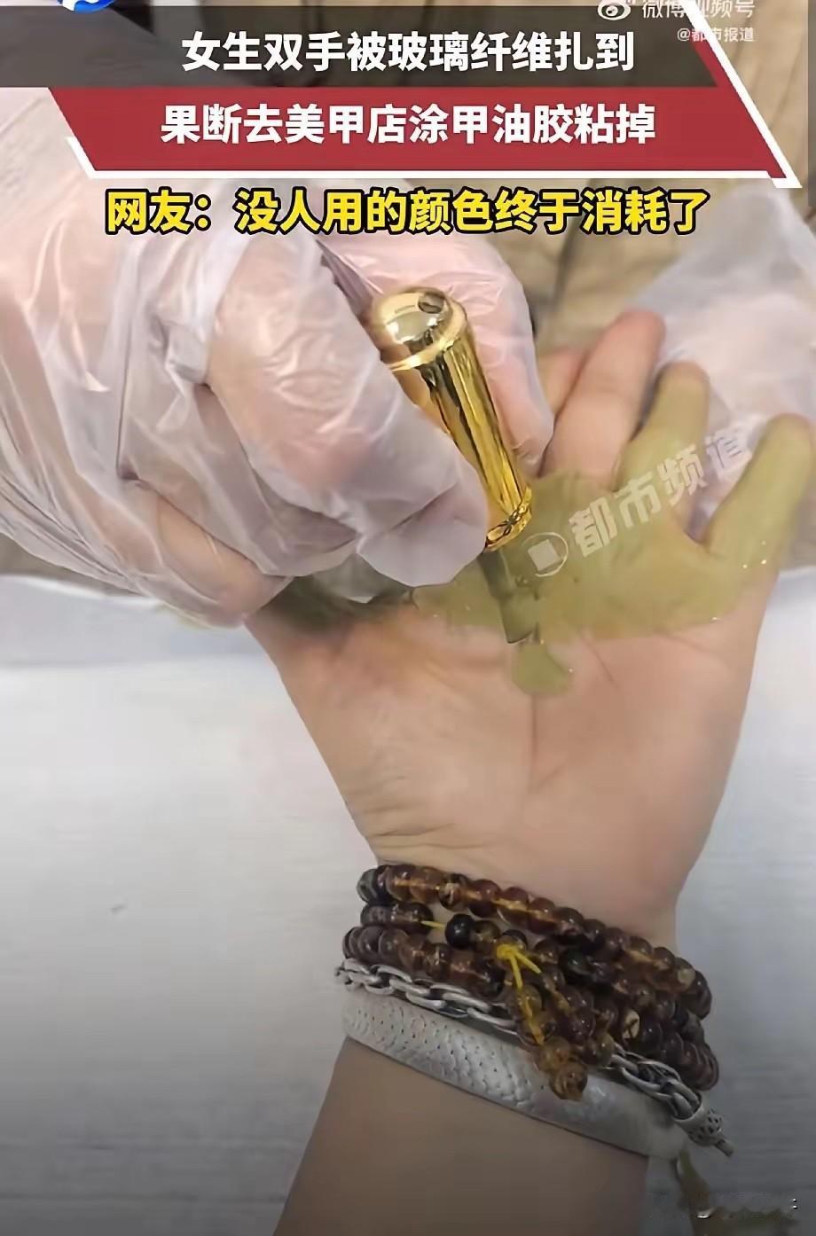 这是真聪明！浙江，一女生双手被玻璃纤维扎到，可她既没有自己拔，没有去医院，而是走