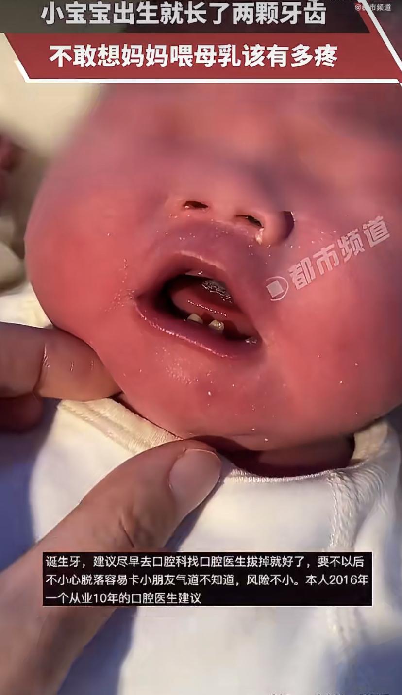 山东一位宝妈最近分享了件稀奇事：自家娃刚出生就自带两颗小牙，可把家里人稀罕坏了!