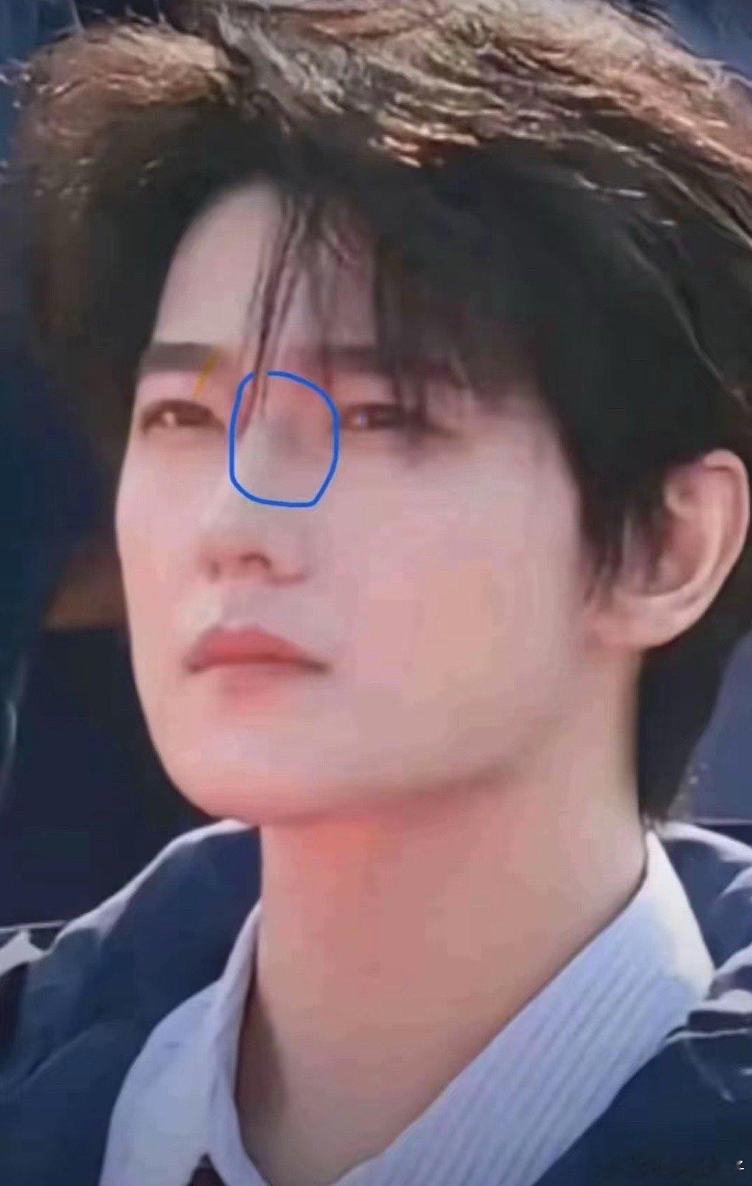 杨洋这鼻子是绝对是淤青 