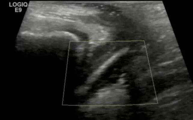 万万没想到！近日，广东，一7岁女孩阴道炎反反复复，家长试过什么办法都不见好，无奈