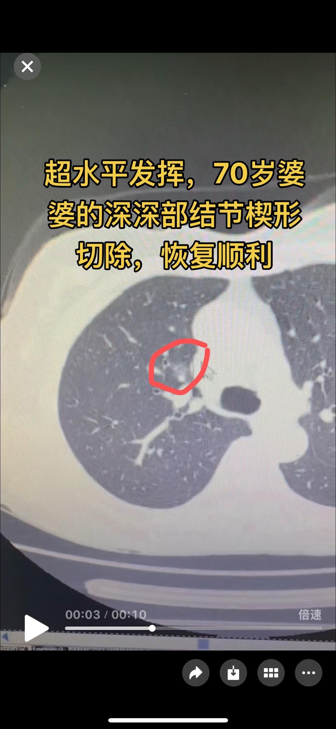 深深部结节的楔形切除。微浸润，一般情况是要切肺段了，这一例我们超水平发...