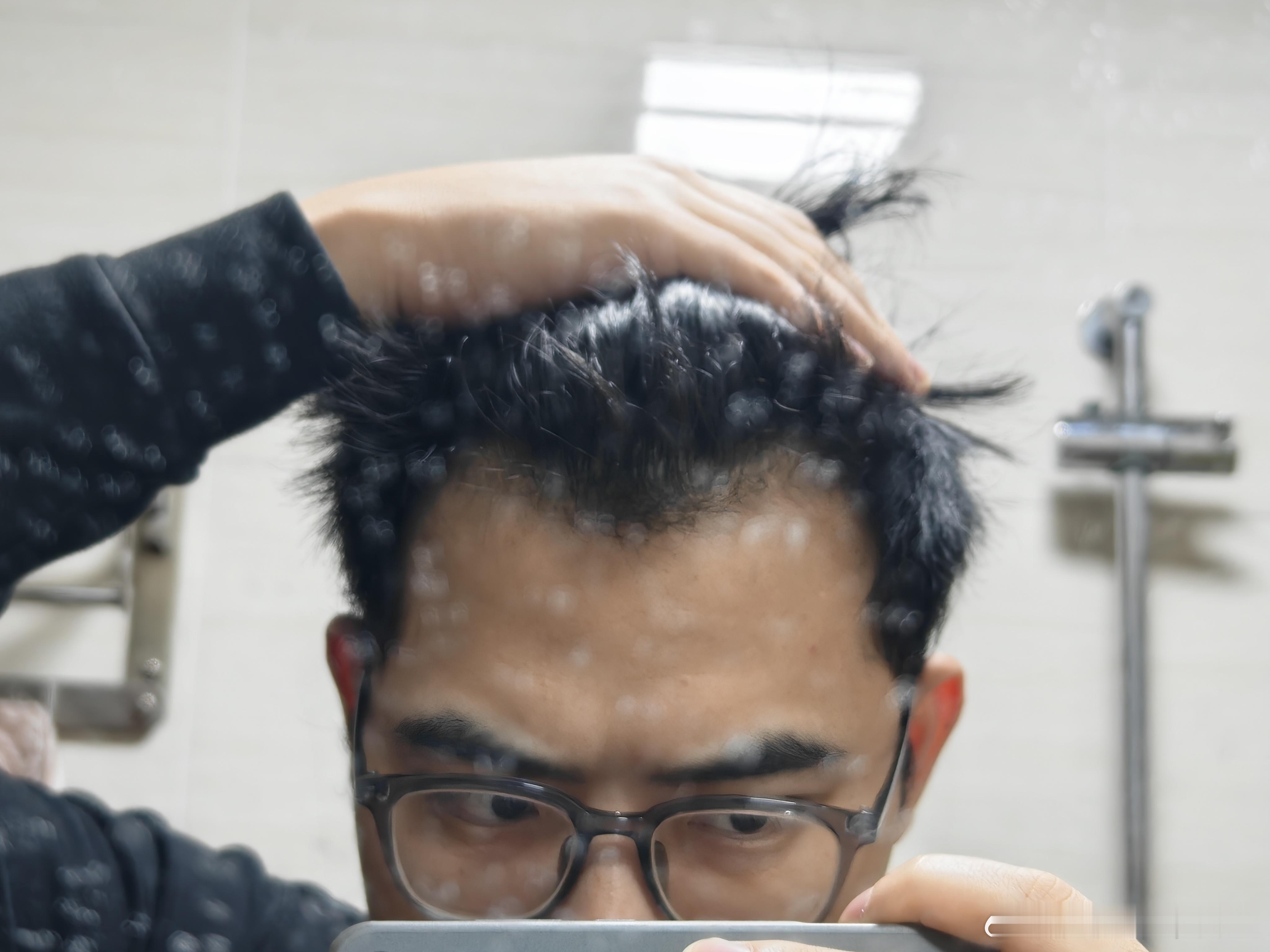 唉，今晚本来是单纯出于分享的目的，跟老家人说了一下，我今年打算抽空做个前额发角植