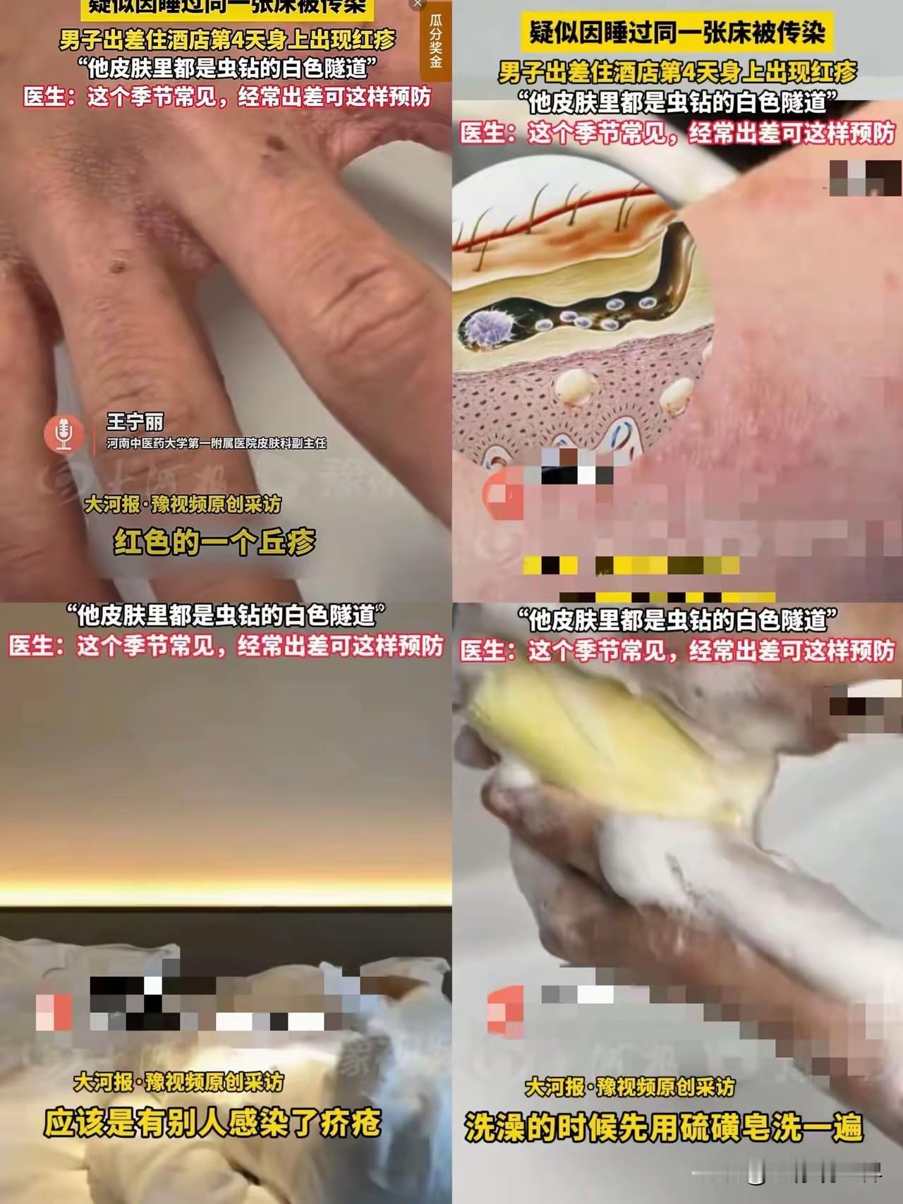 出差住宾馆得了皮肤病，这个问题简直就是无解啊。

谨小慎微，没用啊！你总不能什么