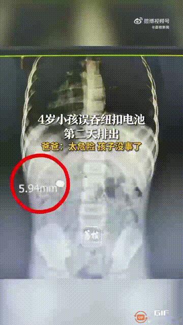 贵州遵义一个4岁孩子在玩玩具时，不慎把里面的纽扣电池抠了出来，然后放进嘴里咀嚼，