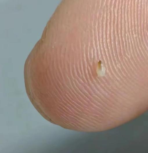 下巴抠出的白色带黑点硬块吓坏我，有没有人能分清到底是什么？
洗脸摸下巴时意外抠出
