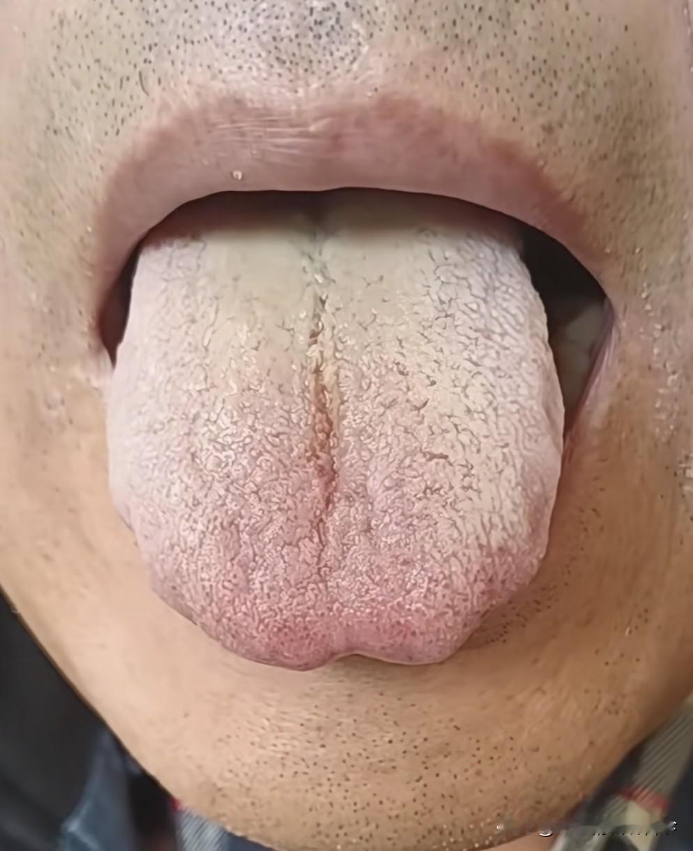 这种舌头，典型的“身兼三项”补不进去！

患者主诉：萎弱不起，阴囊潮湿，前列腺炎