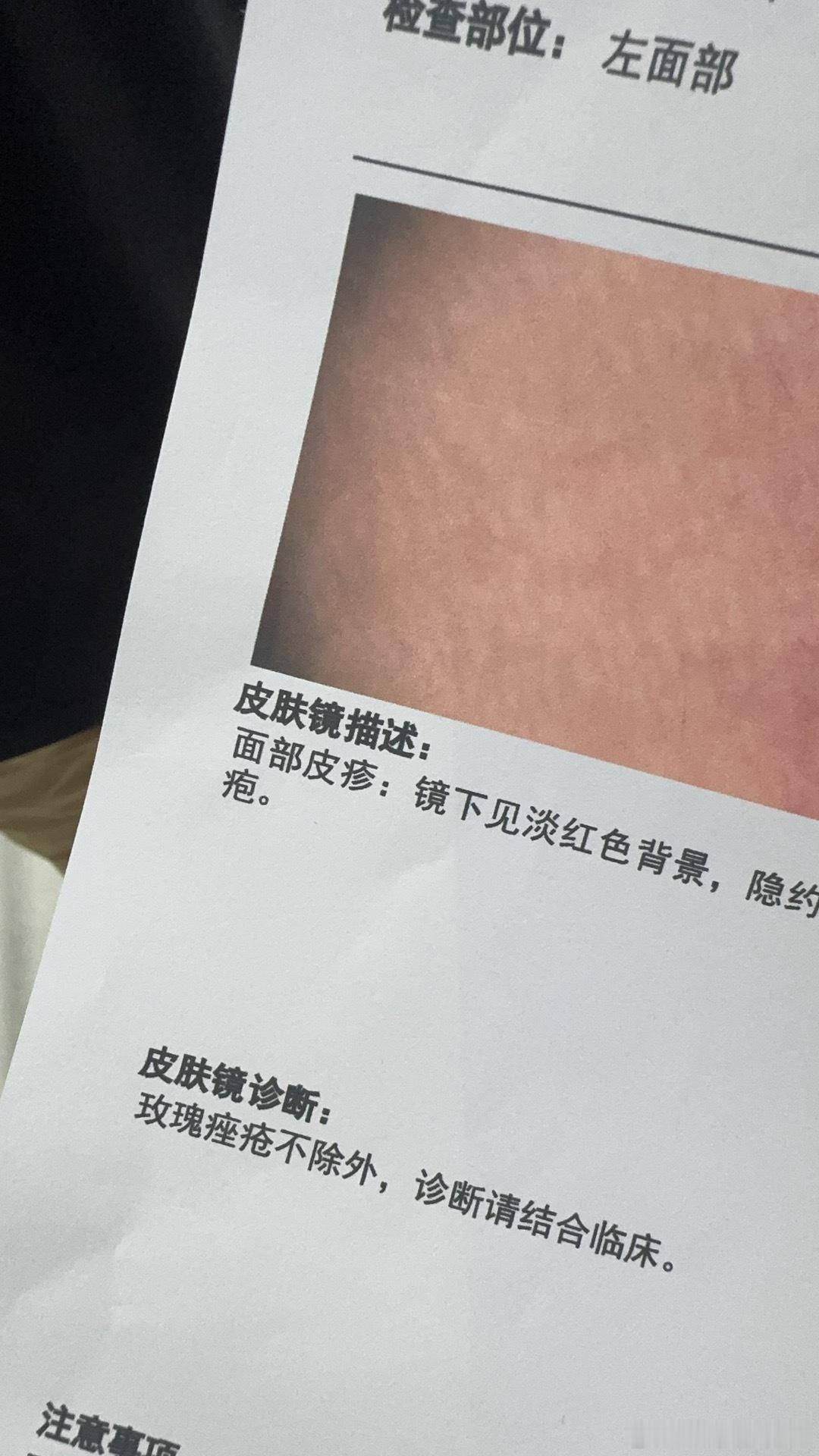 我真的恨死了怎么会是玫瑰痤疮啊