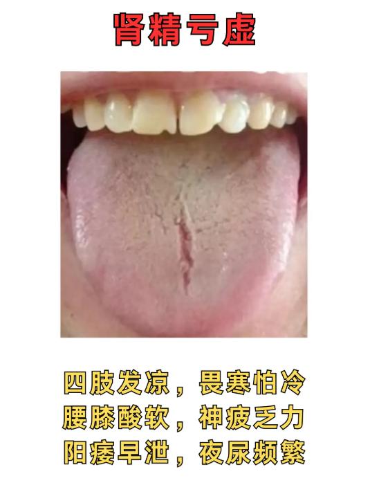 从舌象看男士体质：肾精亏虚、脾肾阳虚等 4 种表现