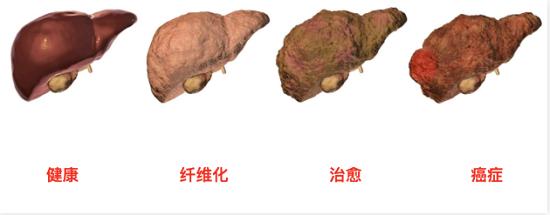 确诊肝癌后还能活多久？会人财两空吗？肝病医生告诉你真相
一般来说，早期肝癌经过积