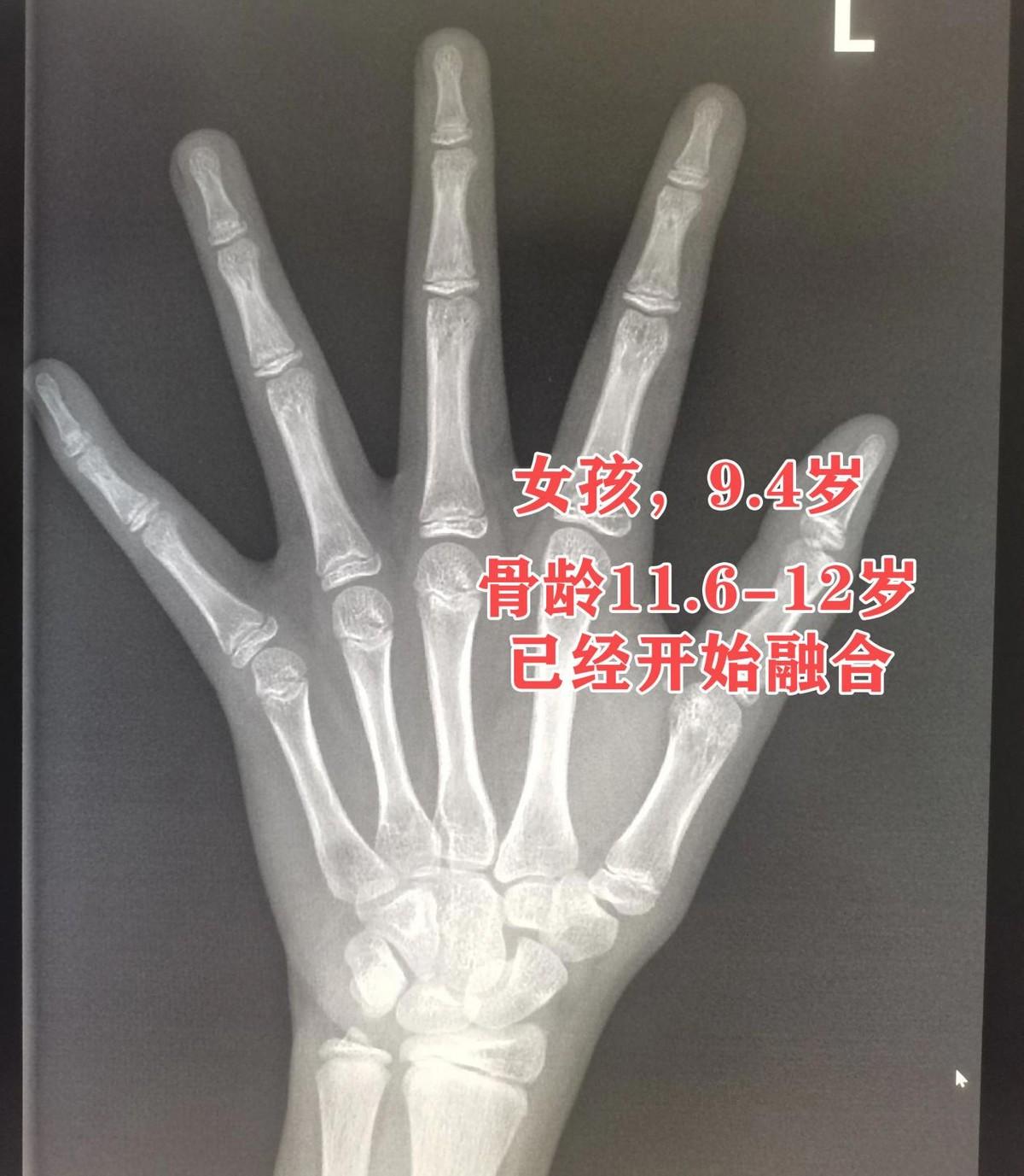 真正偷走孩子身高的不是垃圾零食！9岁女孩性早熟，元凶竟是蛋糕和熬夜？
近日，东莞