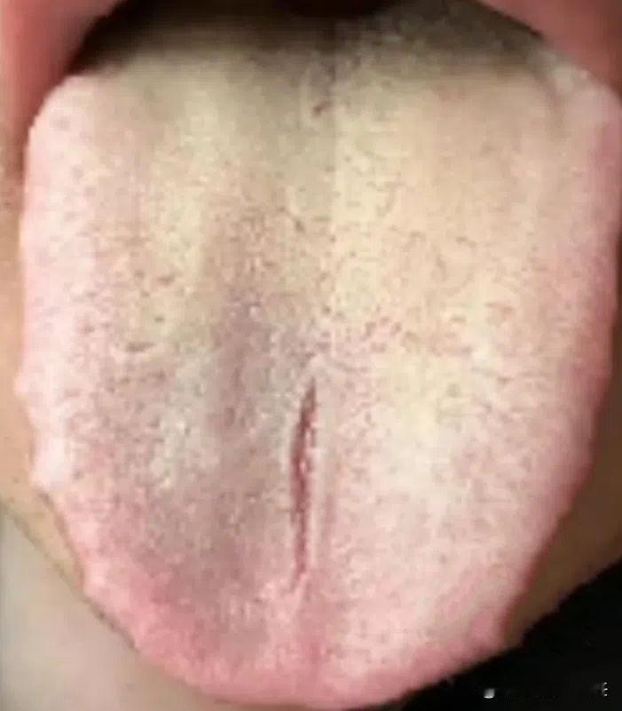 28岁小伙，上来嚷嚷着吃桂附地黄丸没用？一看舌象就知道没少干坏事吧！

患者年纪