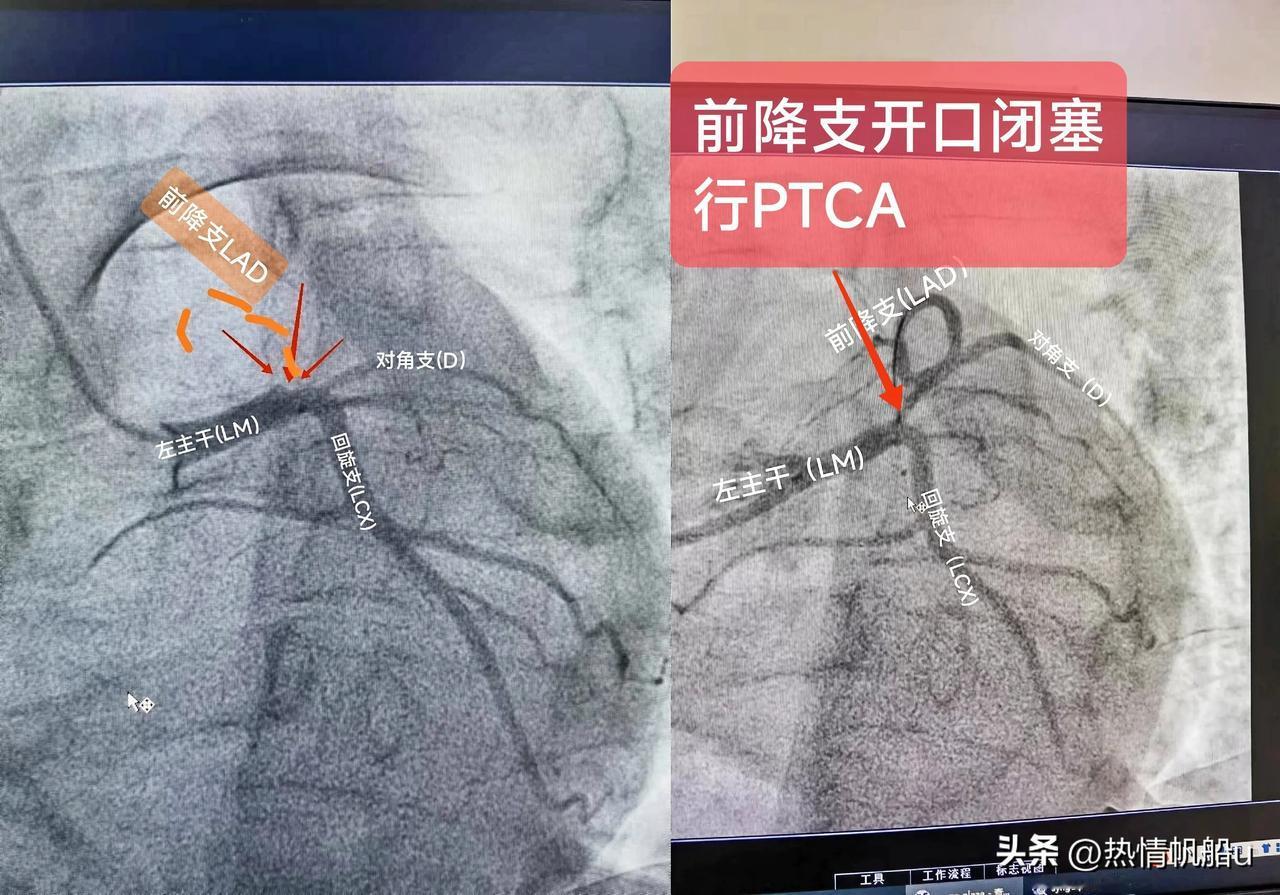 急性ST段抬高型心肌梗死
（前降支开口闭塞，行PTCA术)

一.概念：
左冠状