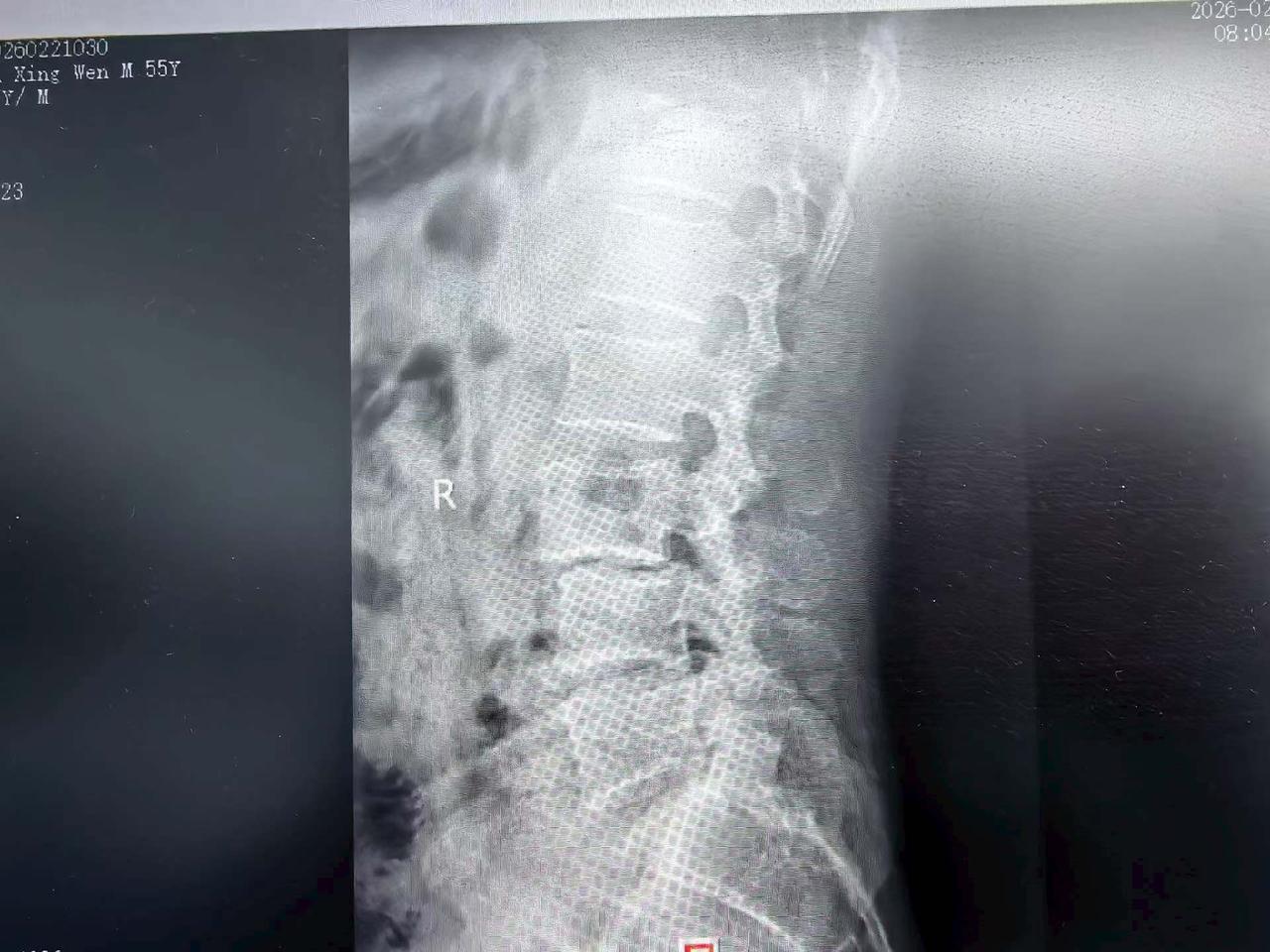 腰椎滑脱真的太折磨人了！就像这位患者，腰痛和右下肢疼痛严重影响生活，之前做了多次