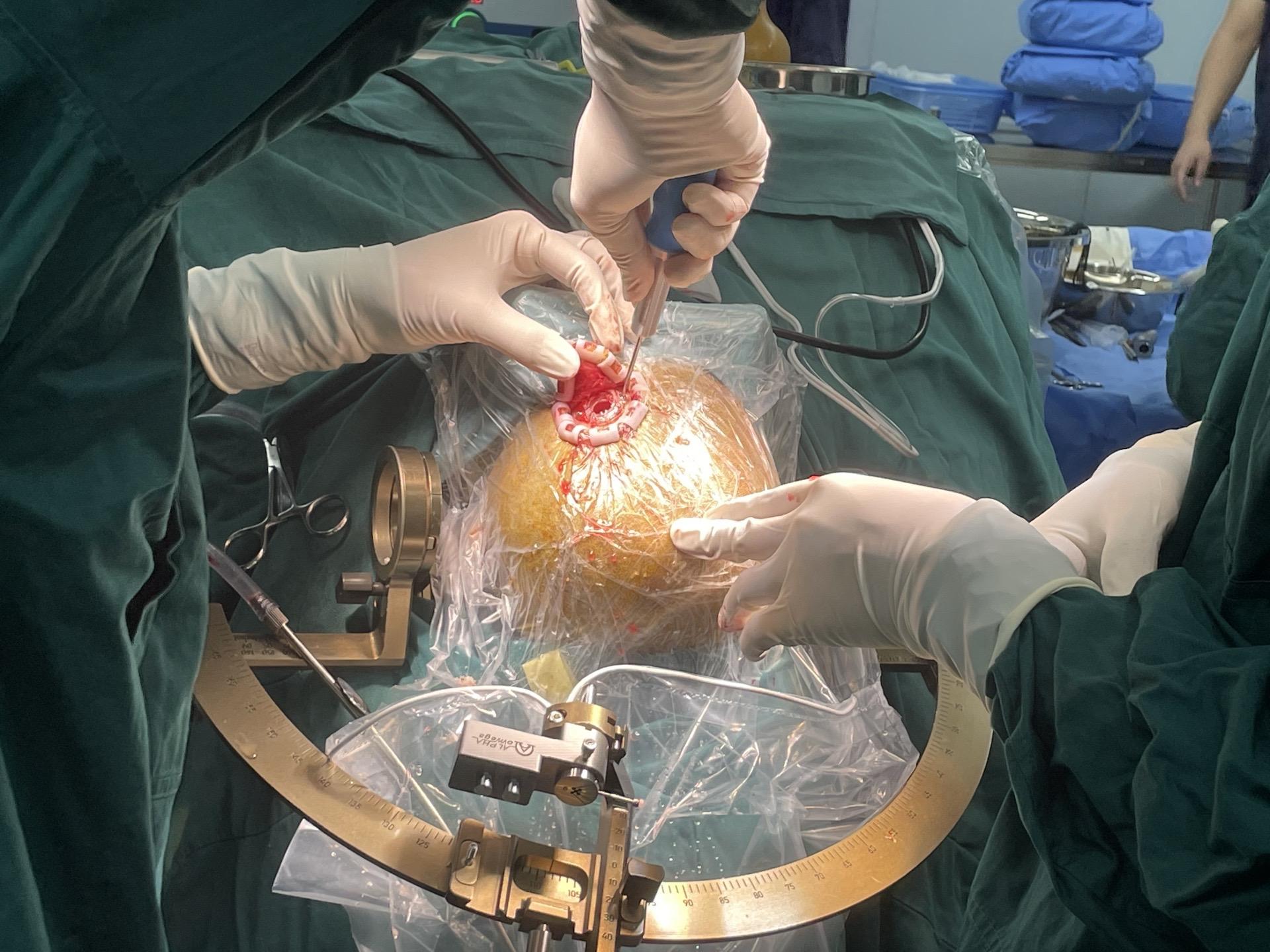 528，和帕金森说再见！520，让秦艾德脑起搏器起效！