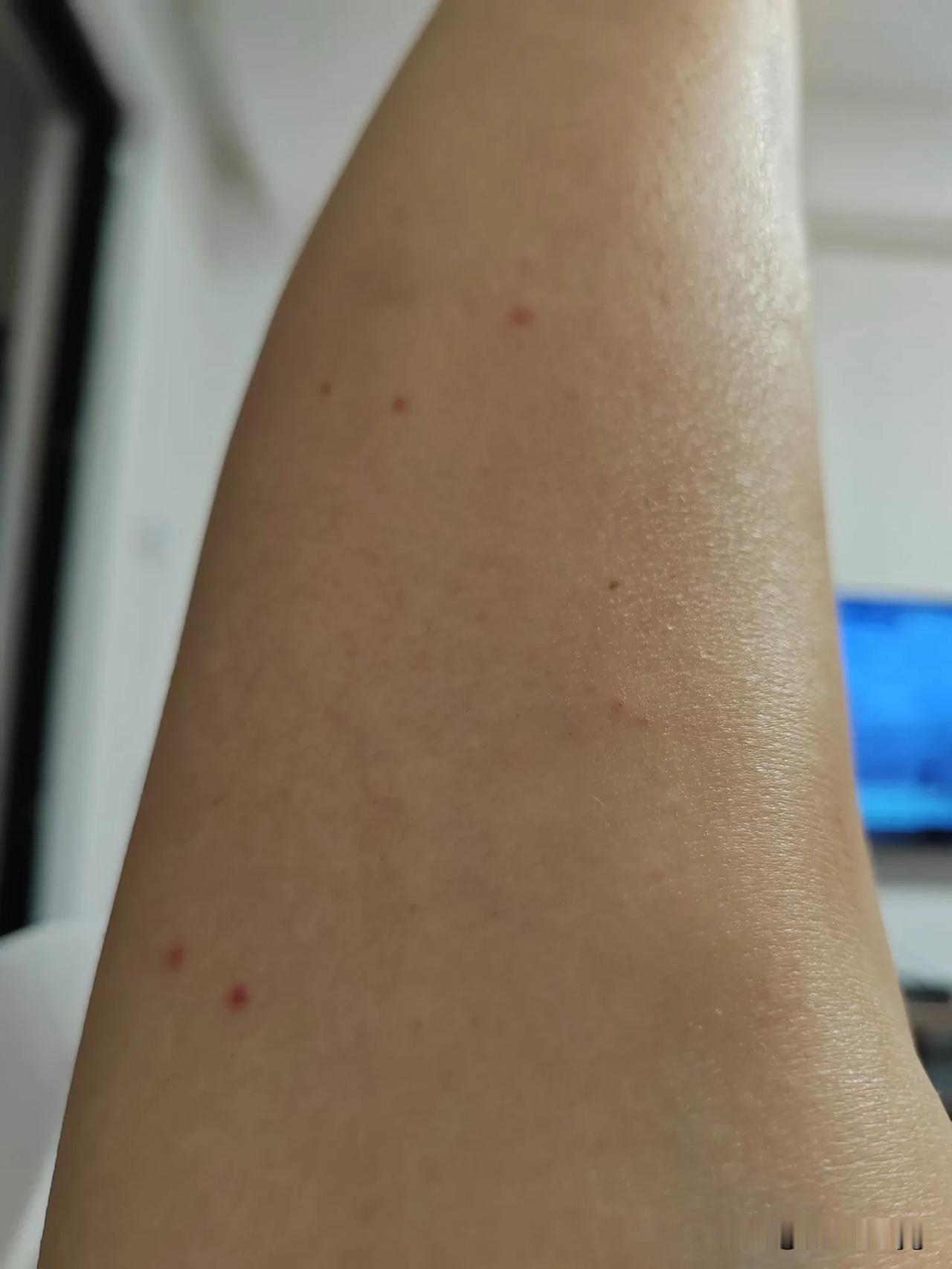 海南的蚊子格外厉害！来到海南，被蚊子咬的遍体鳞伤，并且蚊子咬了以后，会留下小红点