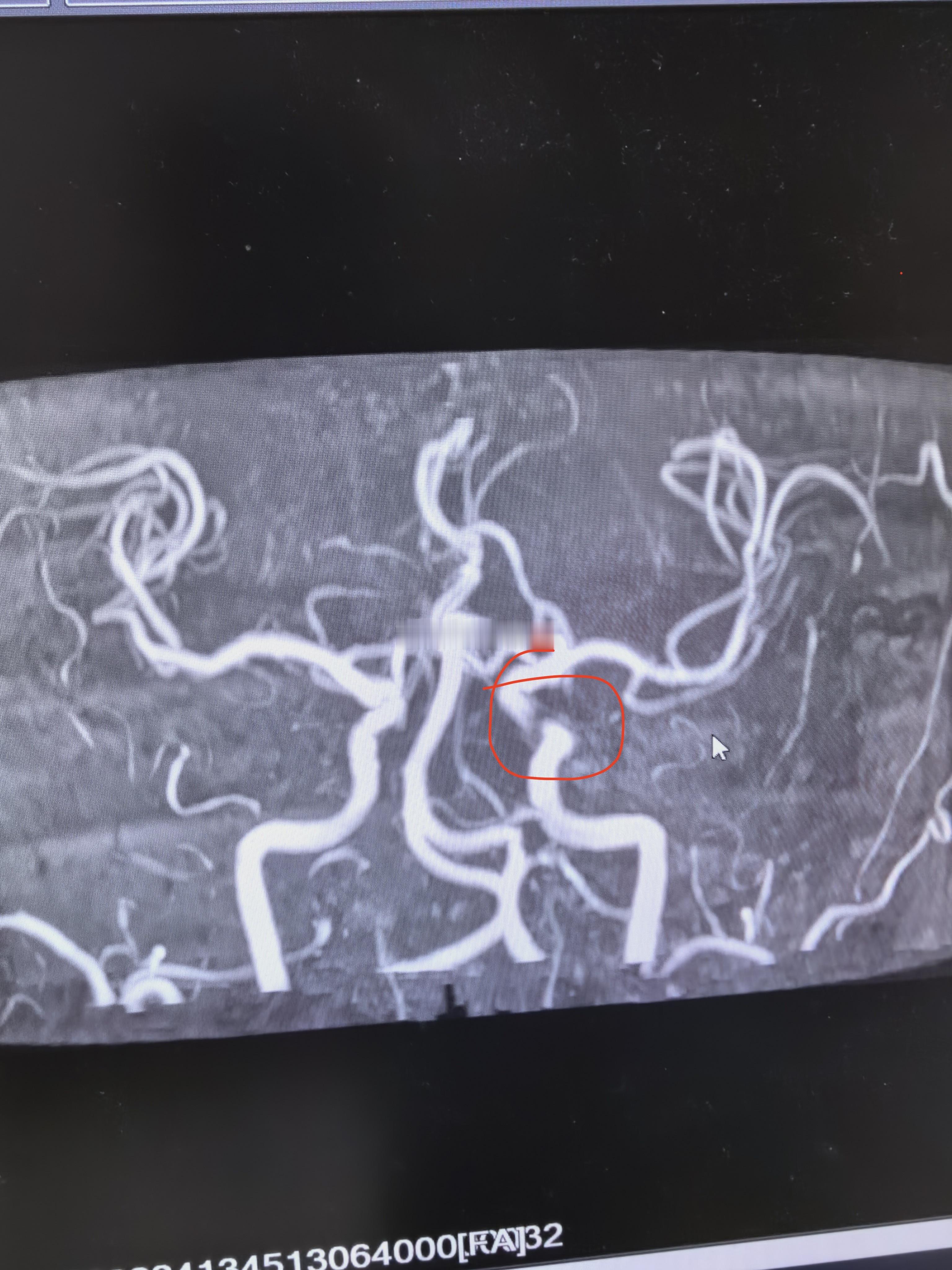 左侧颈内动脉可见一处狭窄，看了下患者2023年的片子，当时没事。 