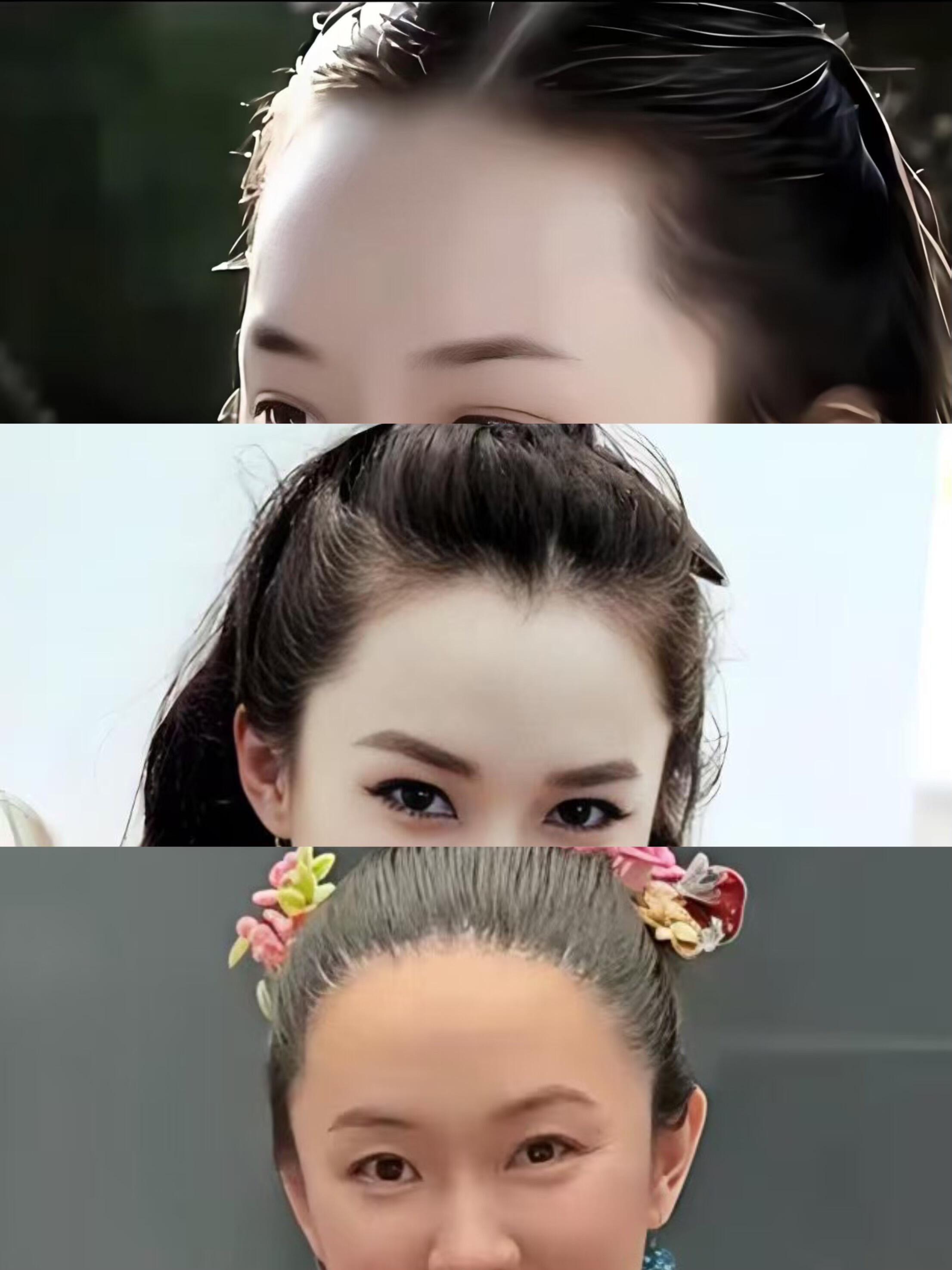 霍思燕发际线还有得救吗 