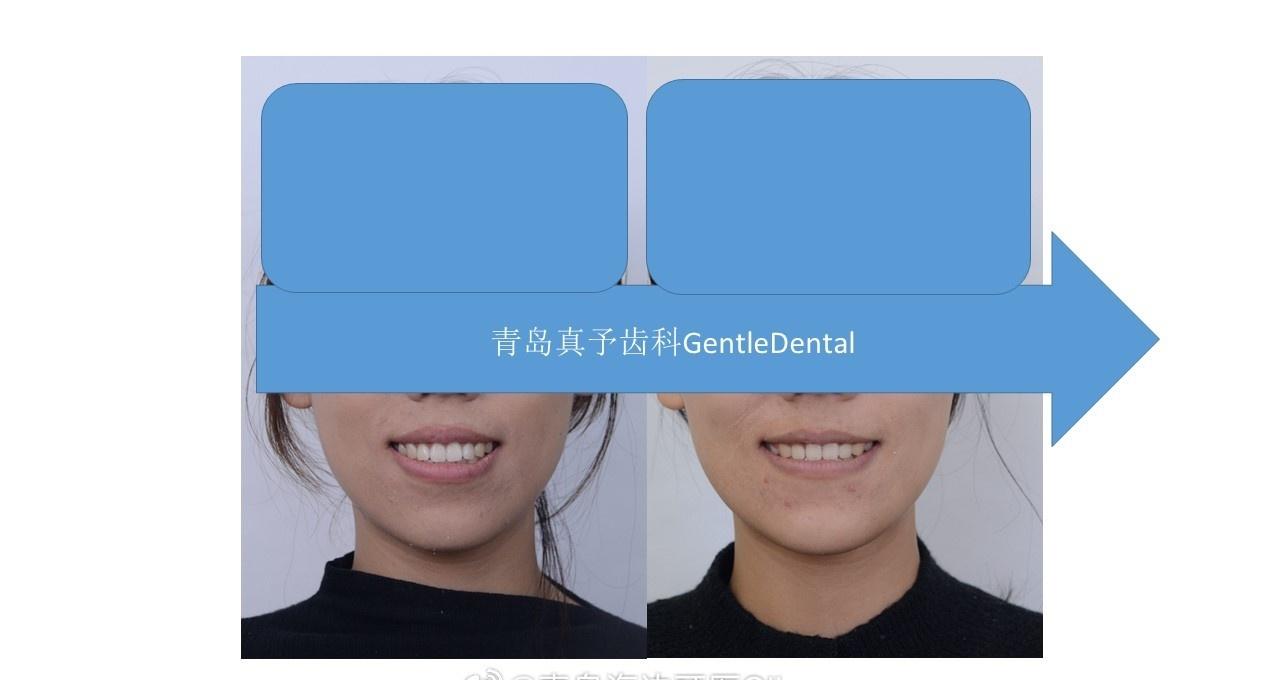 愉快下班。
这位小姑娘也是变化很大，不枉高铁往返的辛苦。
原本下颌高角后旋，有骨