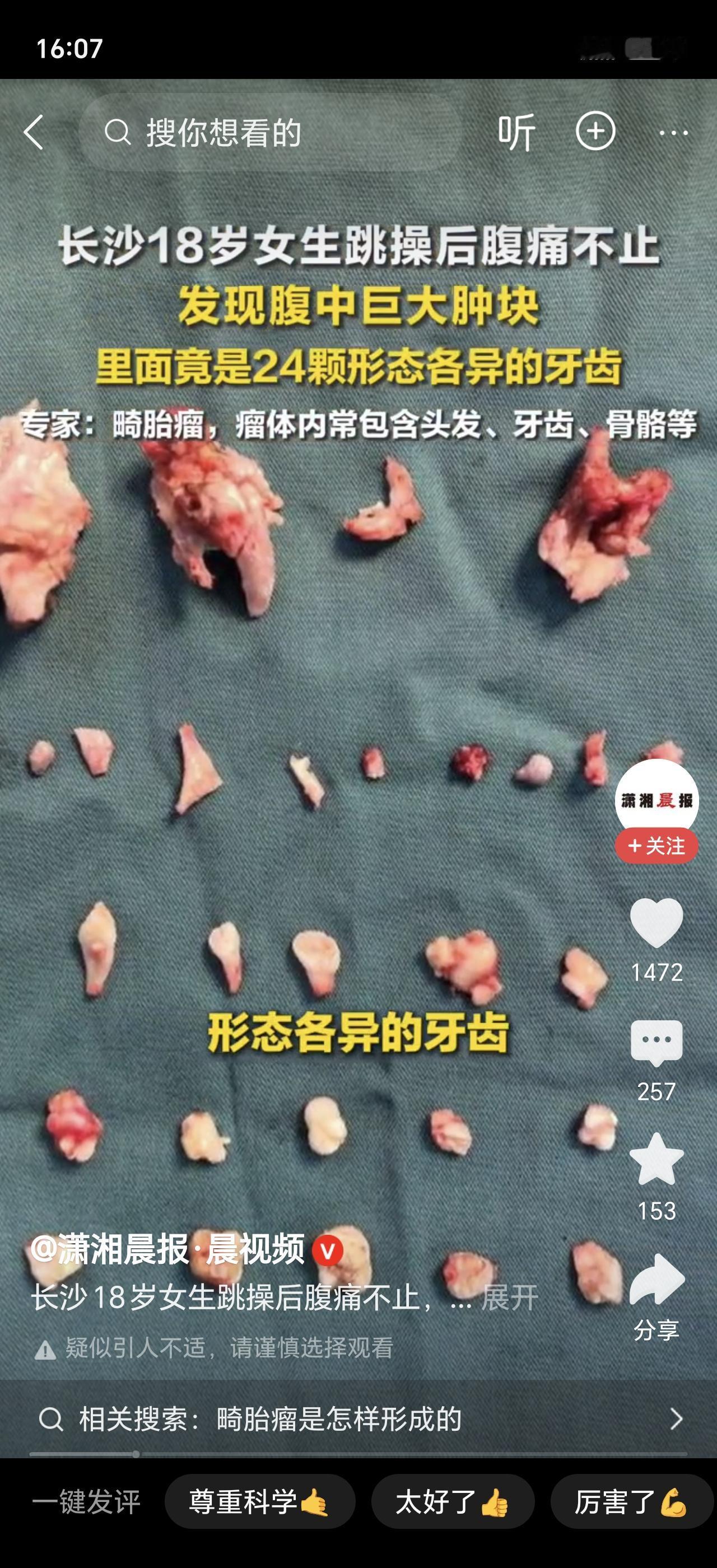 太吓人了！18岁女生跳操后肚子剧痛，去医院一查，腹中竟然藏着一个大肿块！更离谱的