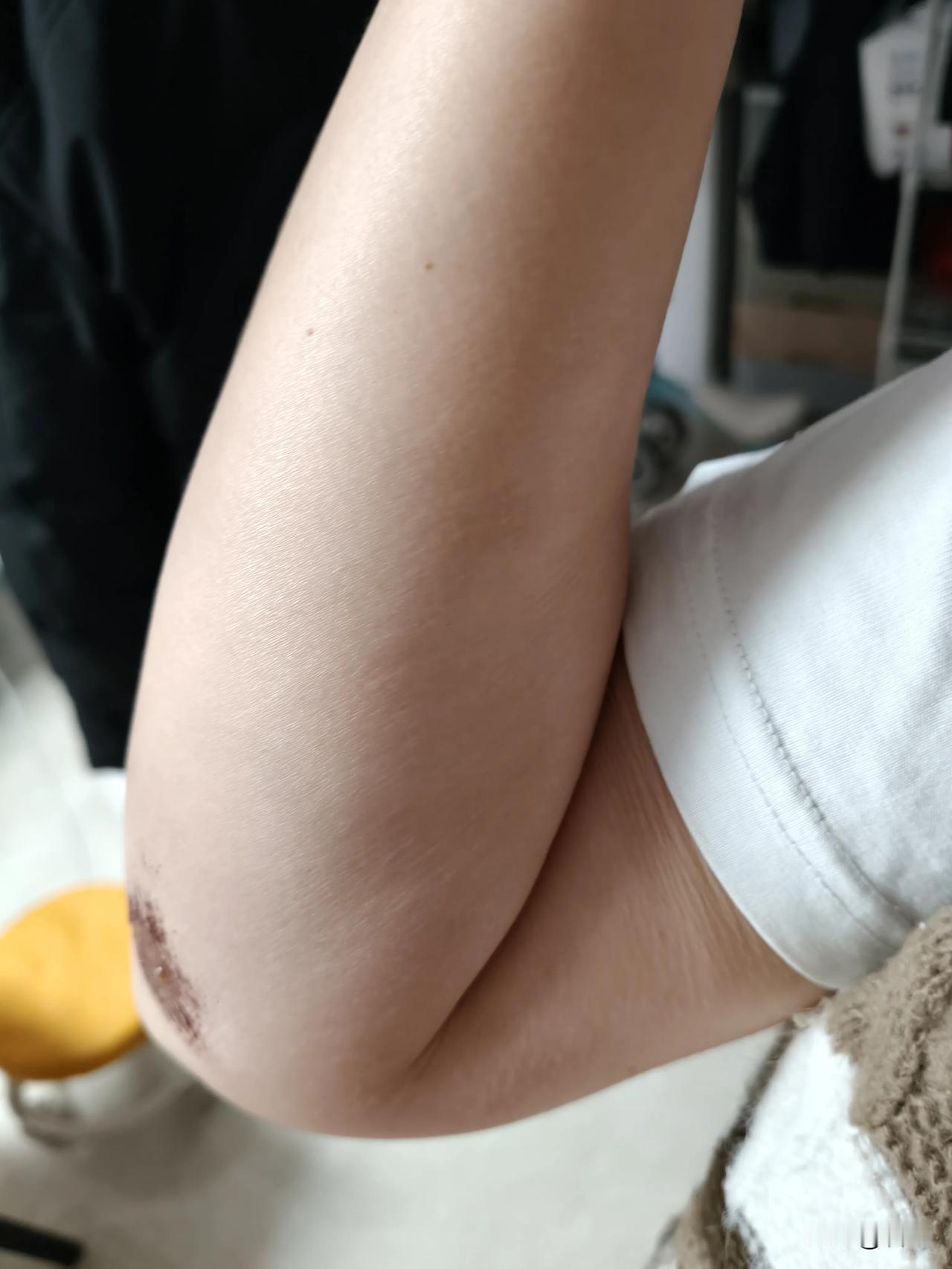 9度的晚上，我穿着短袖，我是疯了吗？

但是不得不这样，这摔一跤，太狠了，裤子破