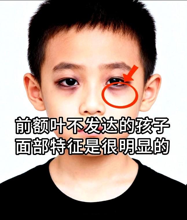 前额叶不发达的孩子面部特征其实很明显！
天哪，每次看到那些前额扁平、眼神涣散的小