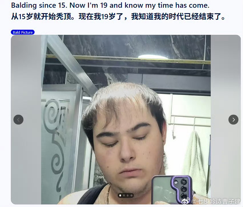 啥玩意儿？你几岁秃顶？ 