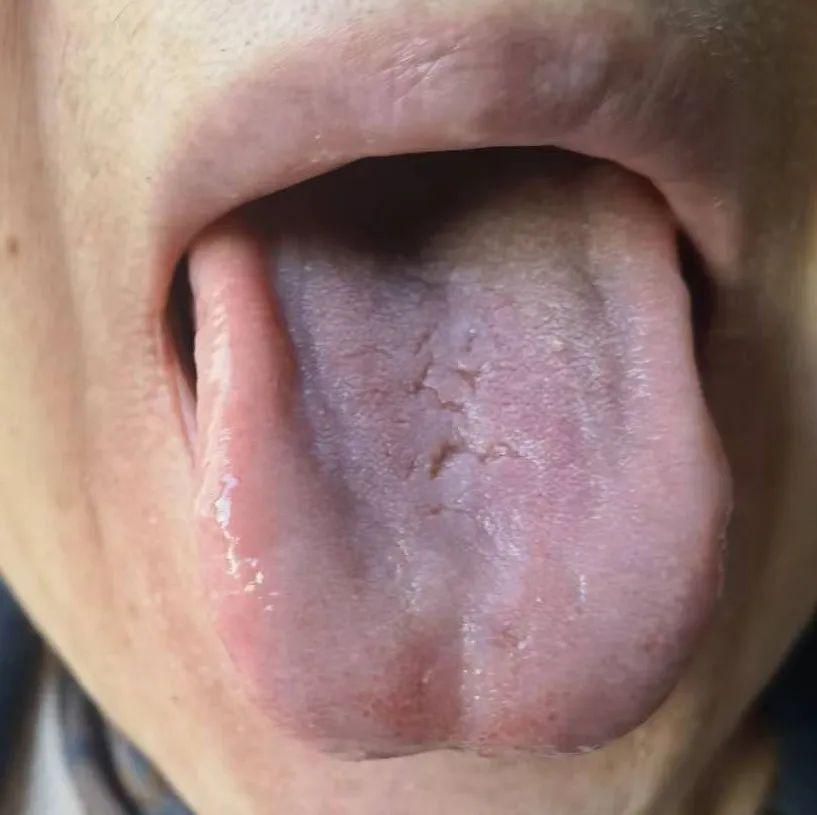 甲状腺疾病发病率非常高
今天给大家分享一例甲减的舌诊病历。
患者女66岁，整体一