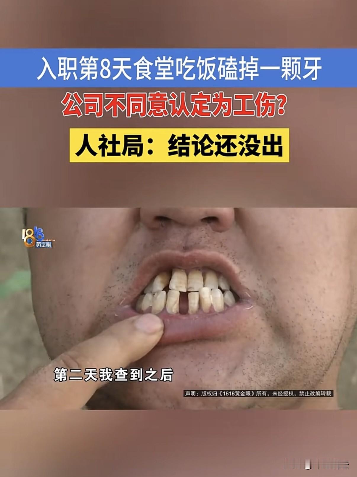 吃饭磕断牙，算不算工伤？浙江湖州，一男子在公司食堂吃饭，被一块鸭骨头卡断了牙齿，