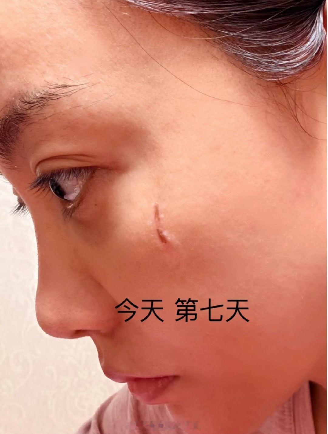 杨蓉晒烫伤后疤痕恢复照  杨蓉晒出烫伤疤痕恢复照，配文说“带疤的脸很酷” 