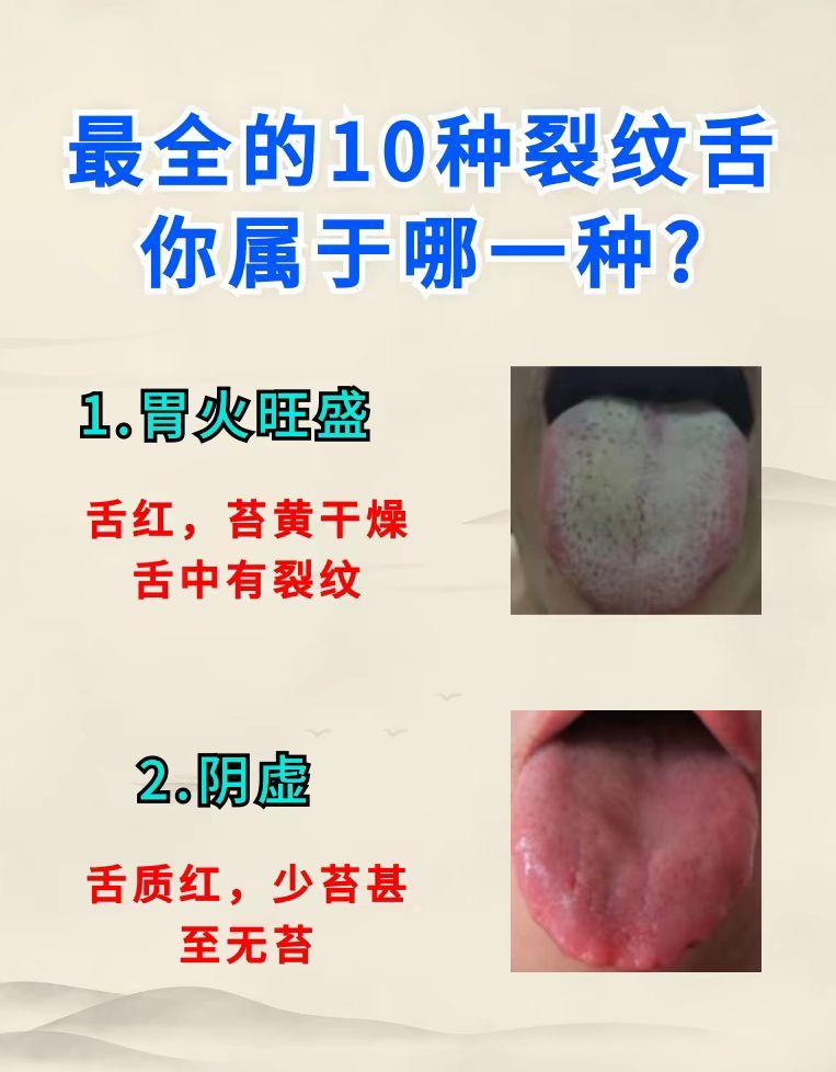 最全的10种裂纹舌 你属于哪一种